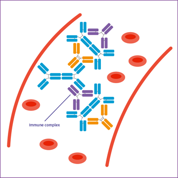 Illustration showing galactose-deficient IgA1 in the circulating blood] 